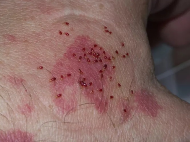 !Bed bugĳ ҧʹ,ЩһС